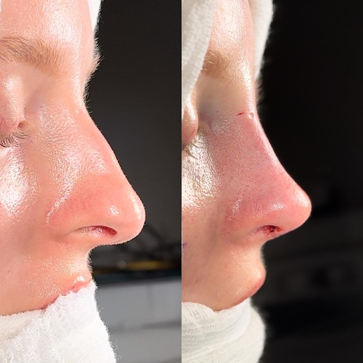 rinoplastia híbrida