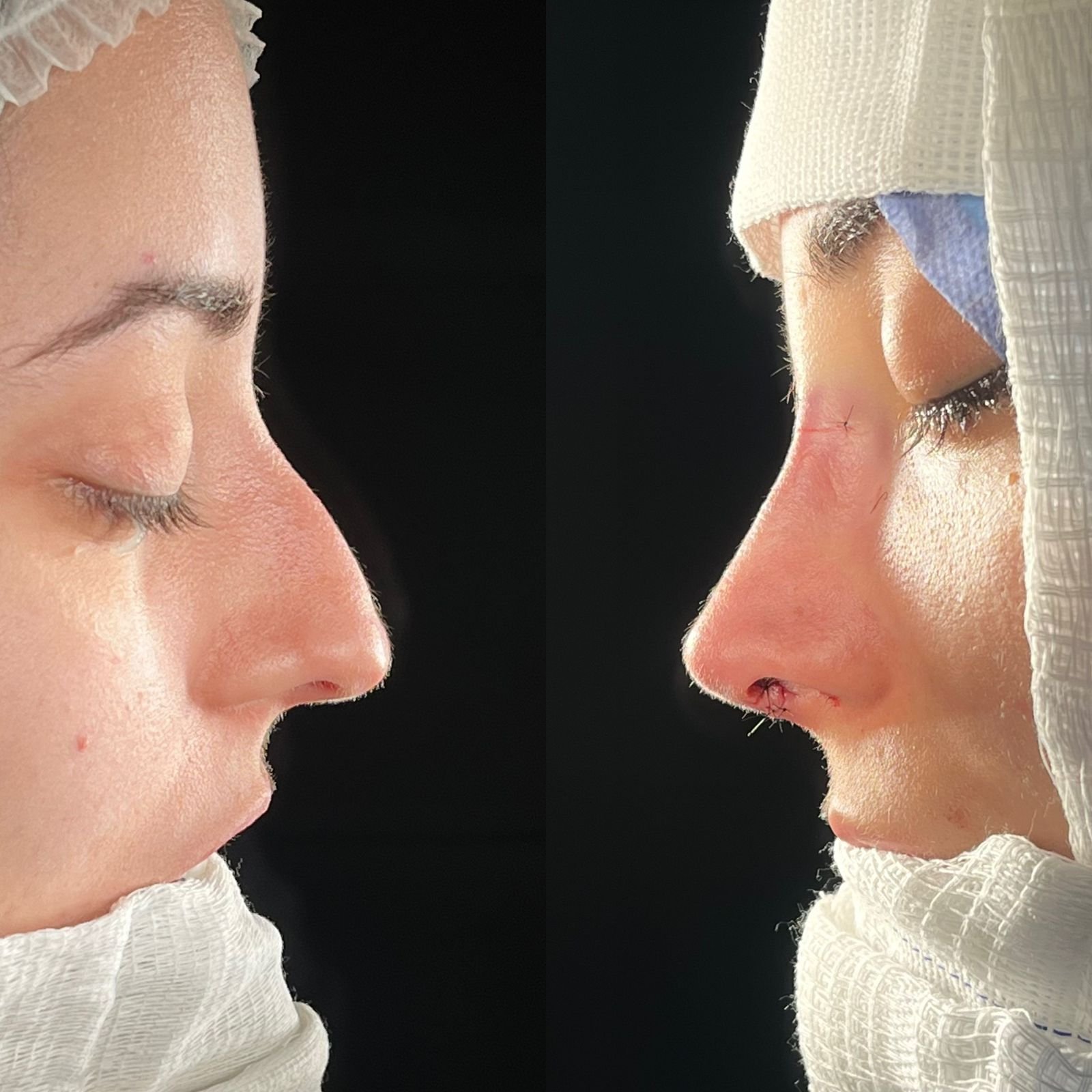 rinoplastia híbrida