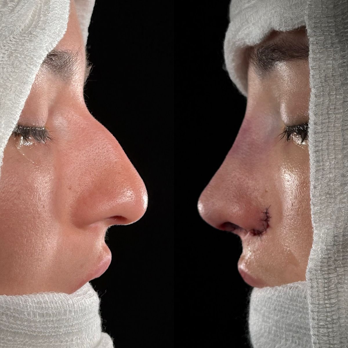 rinoplastia estruturada